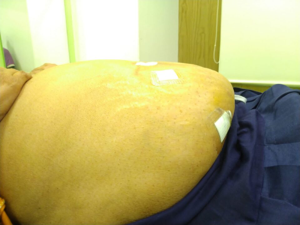 HCG Manavata Cancer Centre performs rare Robotic Surgery on Morbid Obese patient